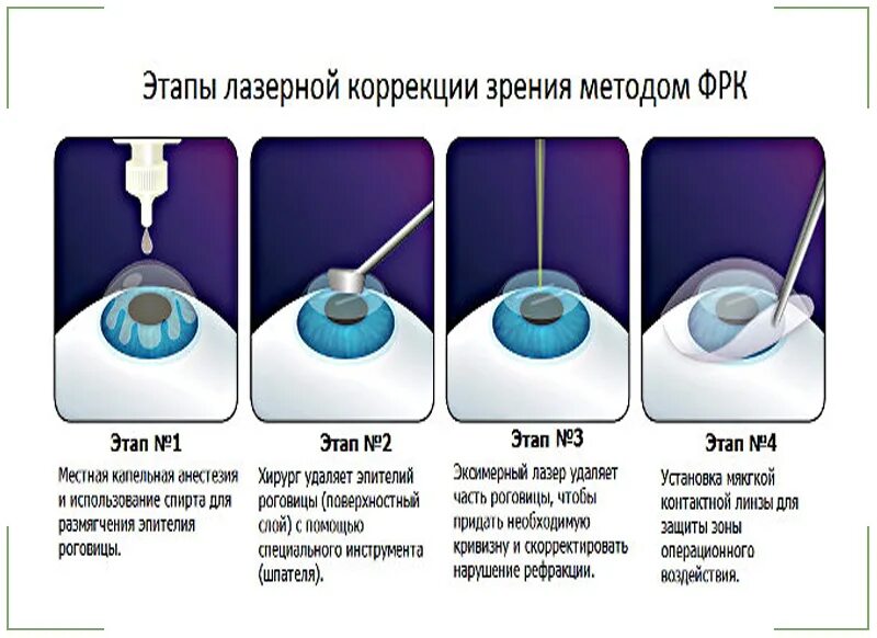 Лазерная коррекция зрения плюсы и минусы мнение. Лазерная коррекция зрения методом ФРК. Метод ФРК лазерная коррекция. Коррекция зрения по технологии ФРК (фоторефракционная кератэктомия).