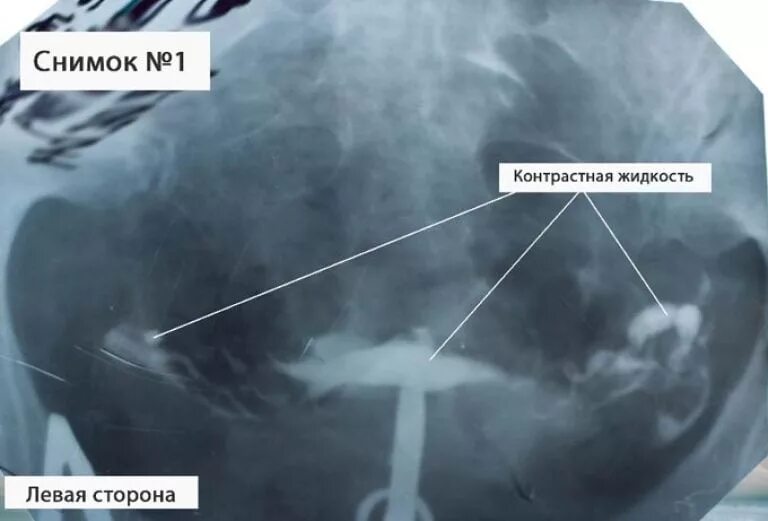 Забеременела при непроходимости труб. МСГ маточных труб снимок. Гистеросальпингография непроходимость маточных труб. Рентген проходимости маточных труб спайки в трубе. Снимки непроходимости маточных труб.