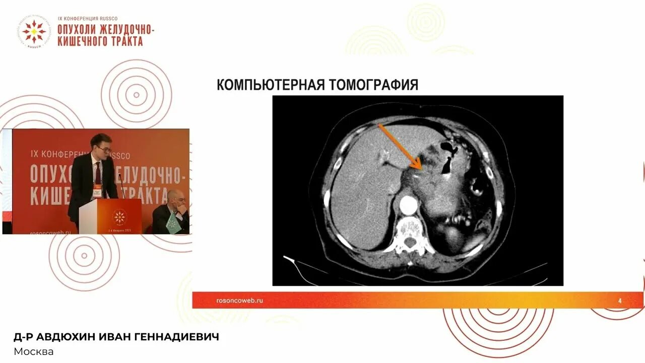 Брюшная лимфаденопатия у ребенка. Внутрибрюшная лимфаденопатия кт. абдоминальная лимфаденопатия. парааортальная лимфаденопатия. забрюшинные опухоли классификация.