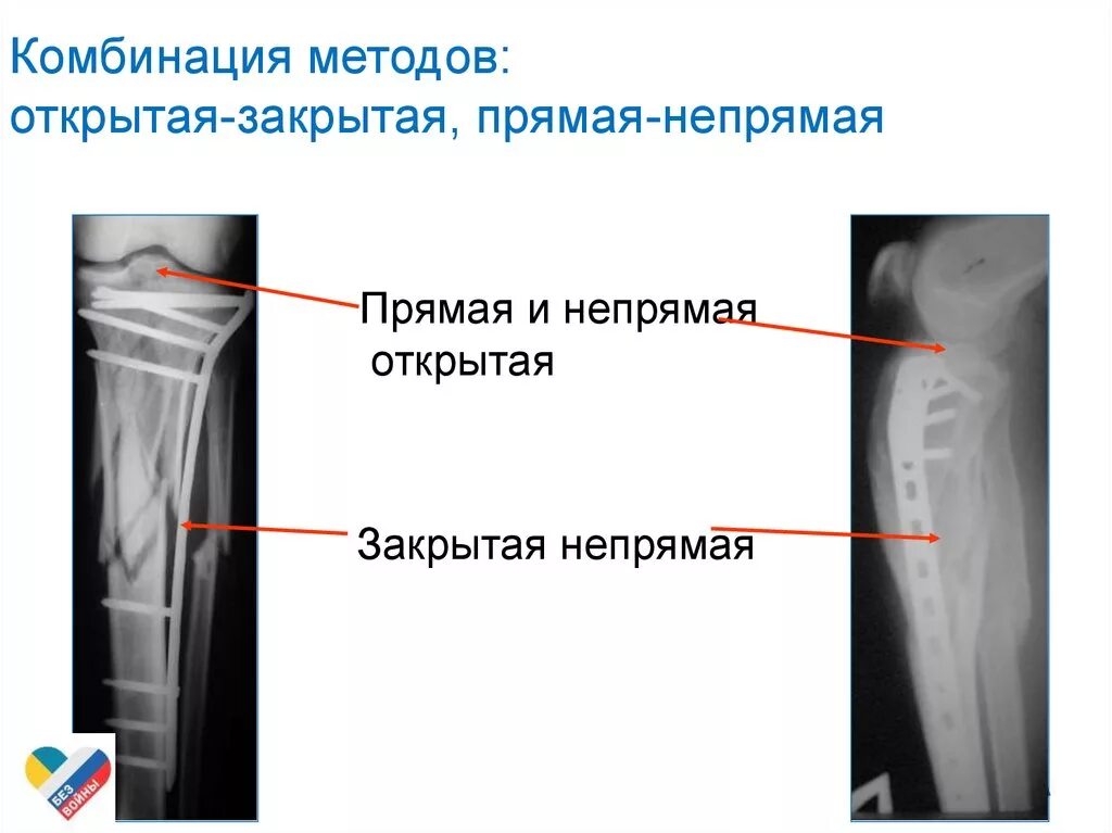 Закрытая репозиция это. Прямая и непрямая репозиция. репозиция костей прямой непрямой. артерэктомия прямая и непрямая.