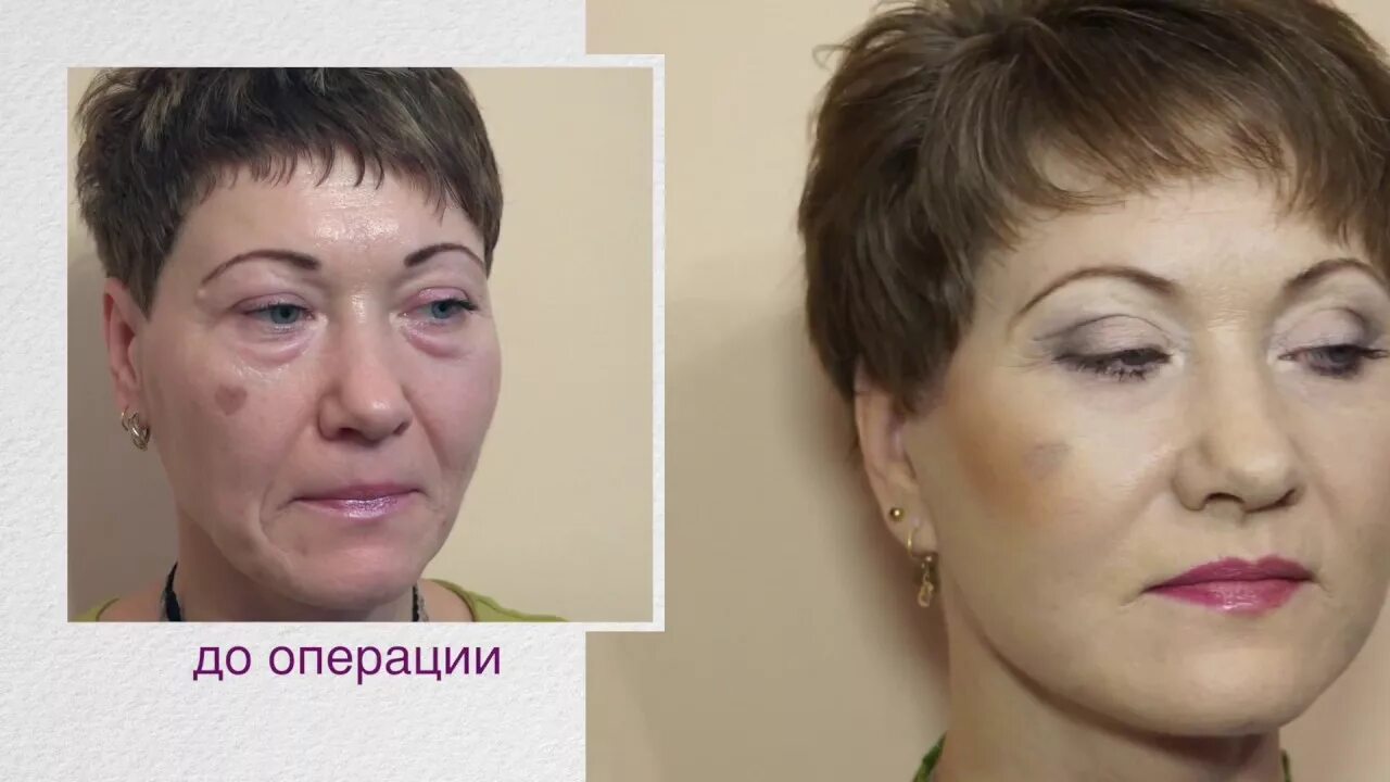 Лифтинг полоски видео