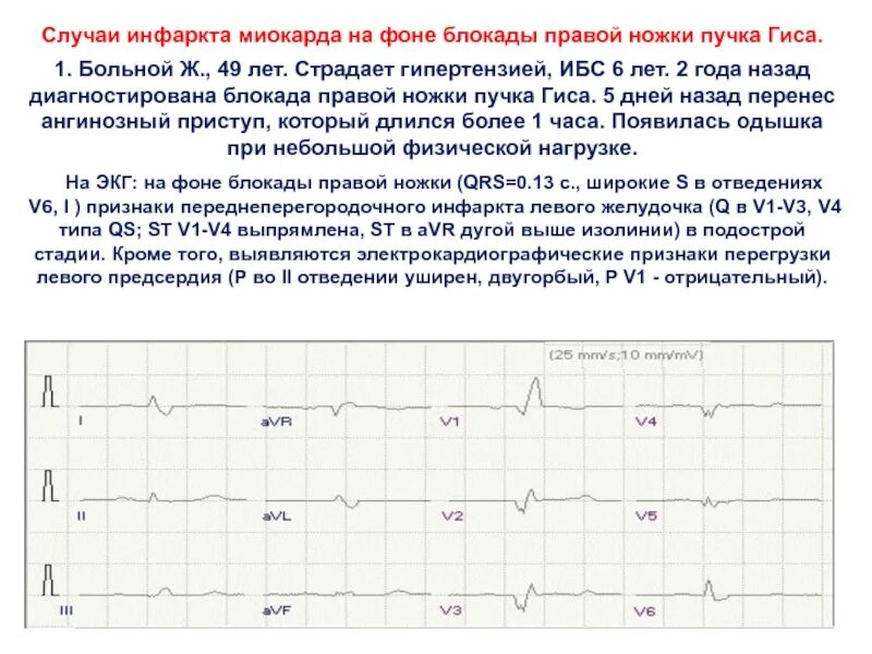 Перенесенный инфаркт миокарда задача. Инфаркт на фоне блокады правой ножки пучка гиса. описание экг при блокаде правой ножки пучка гиса. инфаркт миокарда при блокаде правой ножки пучка гиса. блокада левой ножки пучка гиса и инфаркт миокарда.