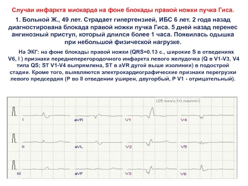 Перенеси назад на 10. Инфаркт на фоне блокады правой ножки пучка Гиса. Описание ЭКГ при блокаде правой ножки пучка Гиса. Инфаркт миокарда при блокаде правой ножки пучка Гиса. Инфаркт миокарда при блокаде левой ножки пучка.