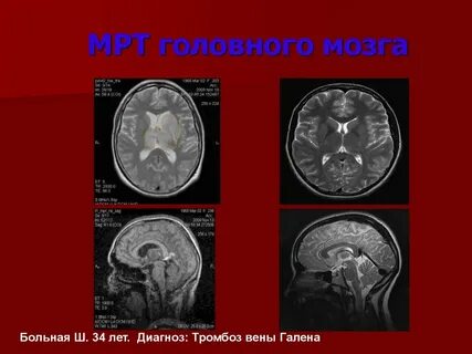 Мрт головного мозга больно