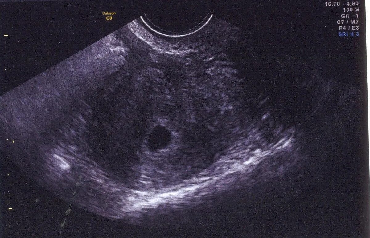 Беременность 2 нед. Беременность 3 недели фото эмбриона на УЗИ. УЗИ 3 недели беременности от зачатия. Беременность 2-3 недели фото плода УЗИ. Беременность на 2-3 недели беременности на УЗИ.