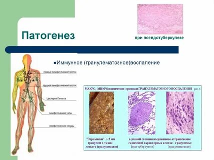 Условия заражения человека псевдотуберкулезом