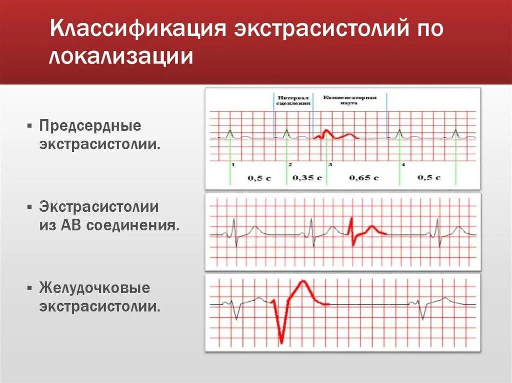 Экстрасистолы это. Предсердная и желудочковая экстрасистолия на ЭКГ. Классификация желудочковые экстрасистолы на ЭКГ. Наджелудочковая предсердная экстрасистолия ЭКГ. Классификация желудочковых экстрасистолий на ЭКГ.
