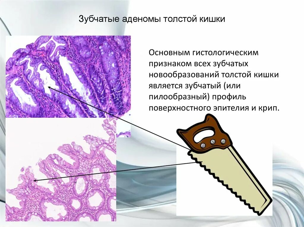 Зубчатая аденома толстой кишки гистология. Зубчатая аденома гистология. Тубулярная аденокарцинома толстой кишки гистология. Зубчатая аденома кишечника гистология. Дисплазия низкой степени толстой кишки что это