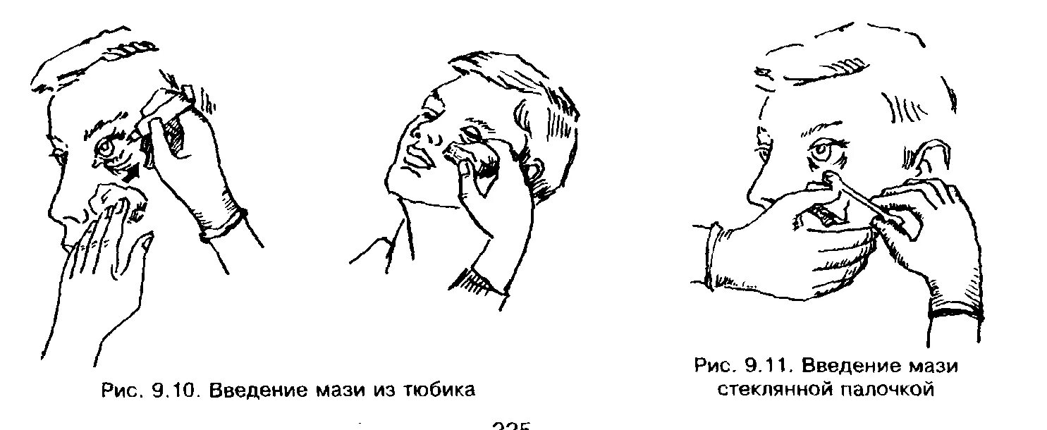 Капли в нос в глаза алгоритм. Закладывание мази за веко алгоритм. Закладывание мази в нос алгоритм. Закладывание мази в глаза алгоритм. Закладывание мази в глаза нос уши алгоритм.