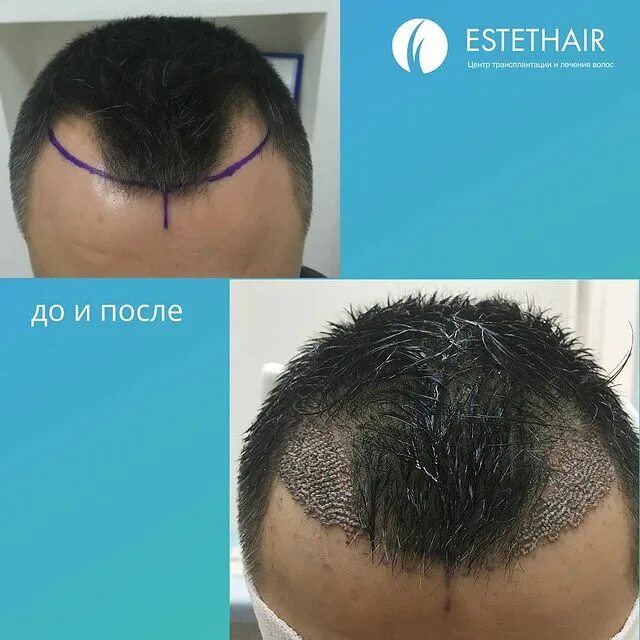 Пересадка волос мужчинам москва. Трансплантация волос методом fue. результат пересадки волос.