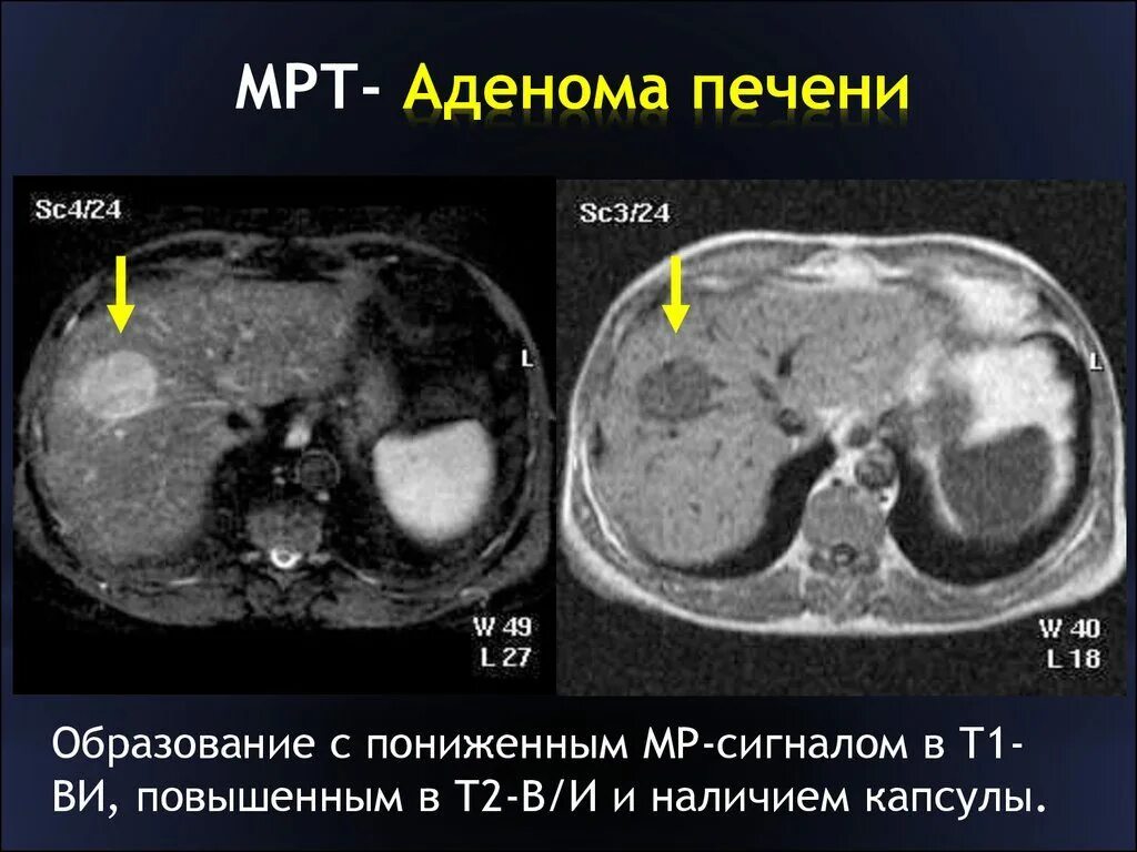 Образования печени кт. Кт признаки аденомы печени. Гепатоцеллюлярная аденома печени кт. Гепатоцеллюлярная аденома мрт.