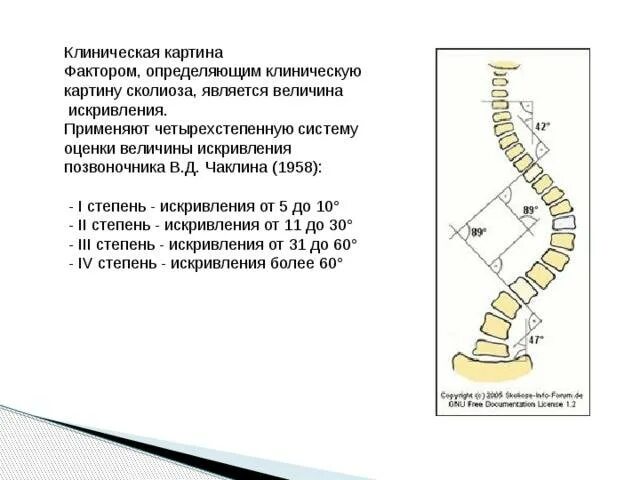 Сколиоз по коббу степени рентген. Сколиоз позвоночника угол Кобба. Степени искривления позвоночника по коббу. Степень сколиоза по коббу степень. Угол кобба