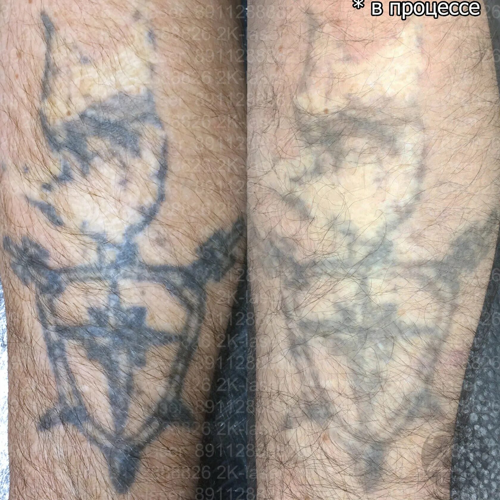Удаление тату неодимовым. Сведение тату до и после. Удаление тату лазером до и после. Лазерное удаление тату до и после.