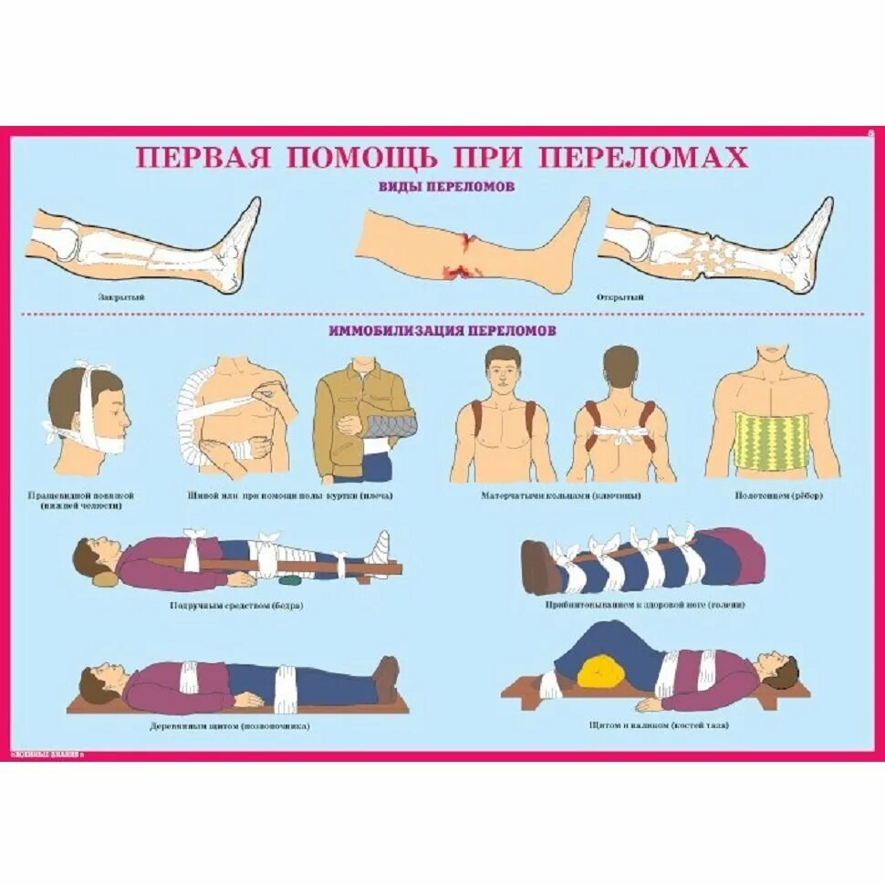 Виды переломов и первая помощь при них. Оказание первой медицинской помощи при переломах. Первая помощбпри переломах. Первая помощь приипереломах. Принципы оказания первой помощи при переломах.