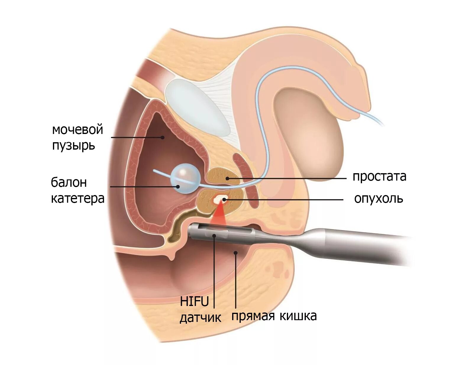 Простата урок. HIFU терапия предстательной железы. Ультразвуковая абляция предстательной железы. Предстательная железа расположение. Расположение предстательной железы в организме мужчины.