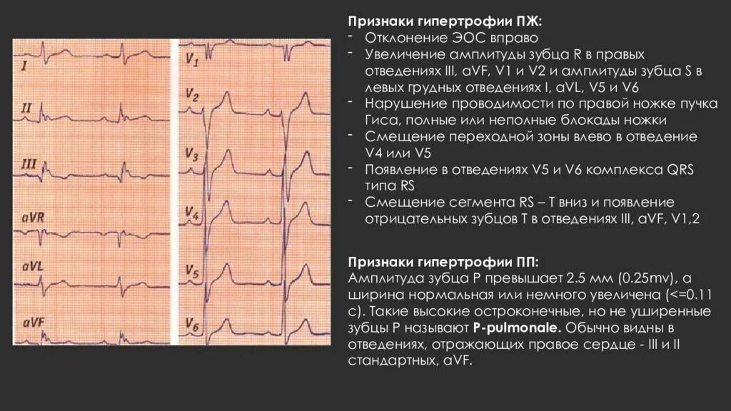Амплитуда зубца r