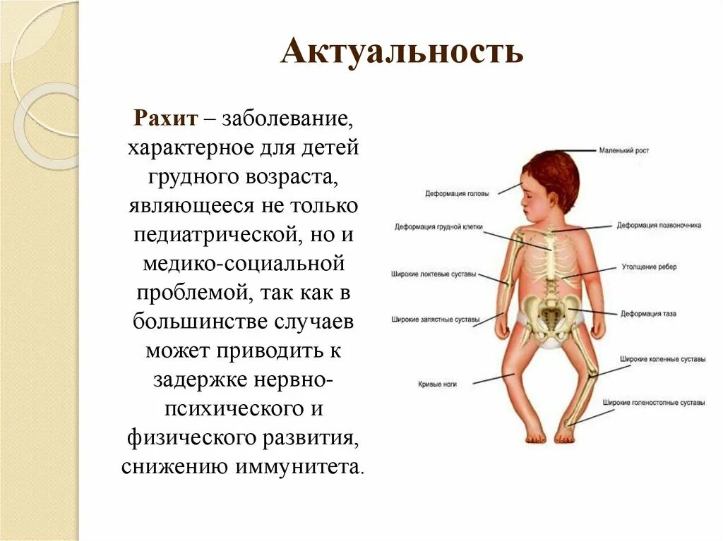 Рахит у детей какие