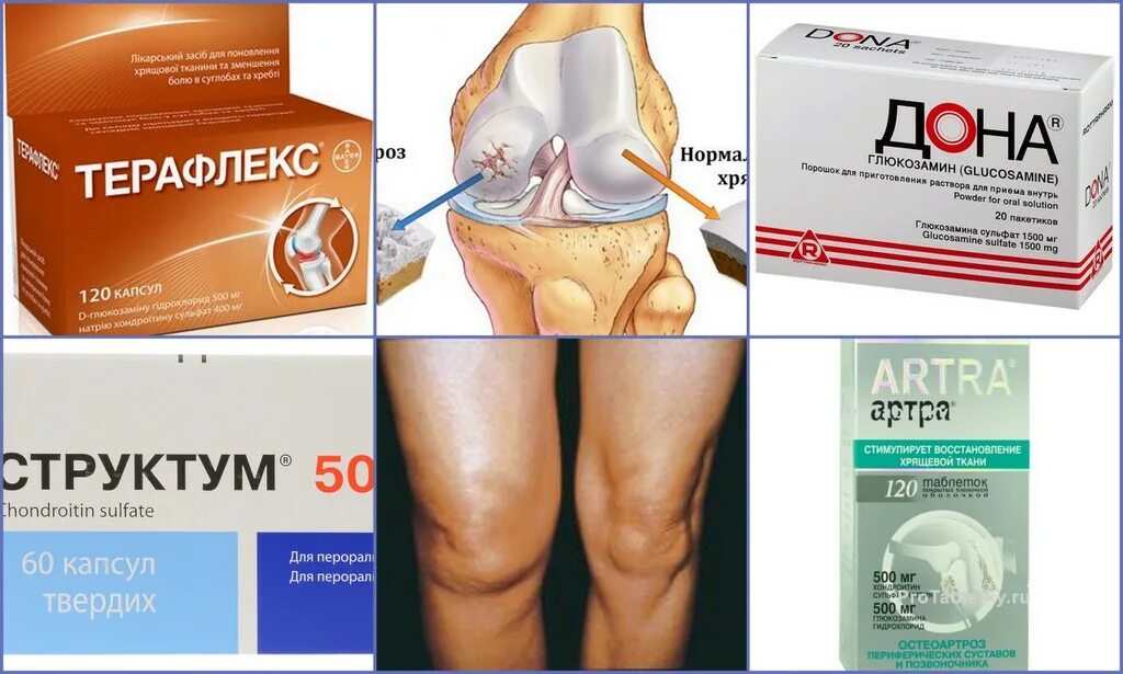 Таблетки от артрита суставов артра. Препараты при артрозе коленного сустава 1. Таблетки от артрита суставов недорогие. Таблетки для лечения коленного сустава препараты.