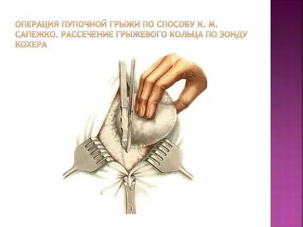 Виды операций пупочных грыж