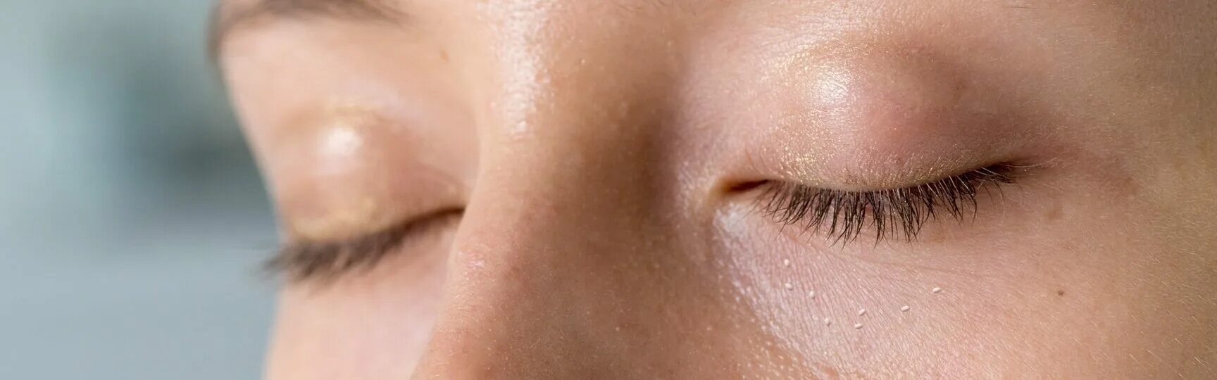How to Get Rid of Milia: Causes, Prevention, and Removal
