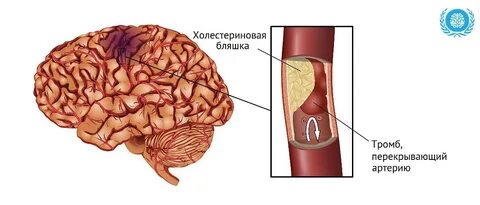 Ишемический инсульт головы