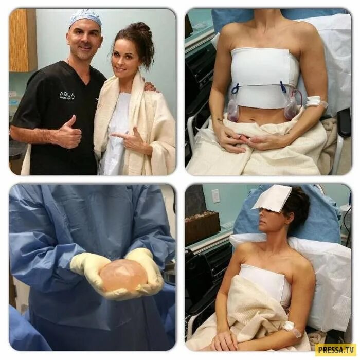 Как выглядит грудь после имплантов Teardrop Implant For Breast Augmentation Surgery In Delhi Teardrop Vs Round Impl