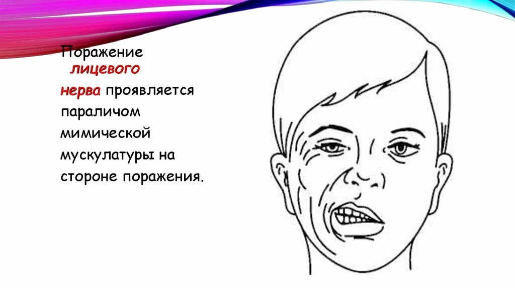 Поражение лицевого нерва. Периферический паралич мимической мускулатуры справа. Симптомы поражения лицевого нерва. Парез мимической мускулатуры.