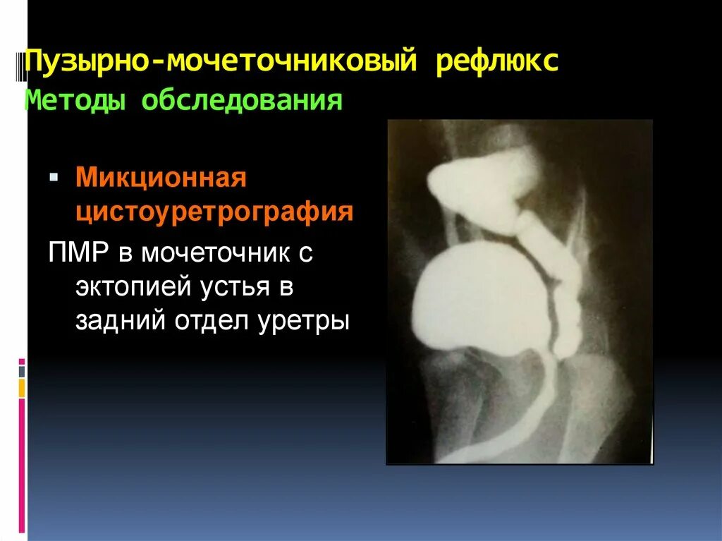 Рефлюкс мочеточника. Пузырно-мочеточниковый рефлюкс цистоуретрография. Пузырно мочеточниковый рефлюкс цистография. Микционная цистография ПМР.