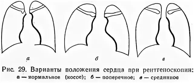Типы положения сердца. Варианты положения сердца. косое положение сердца. расположение сердца гиперстеников.