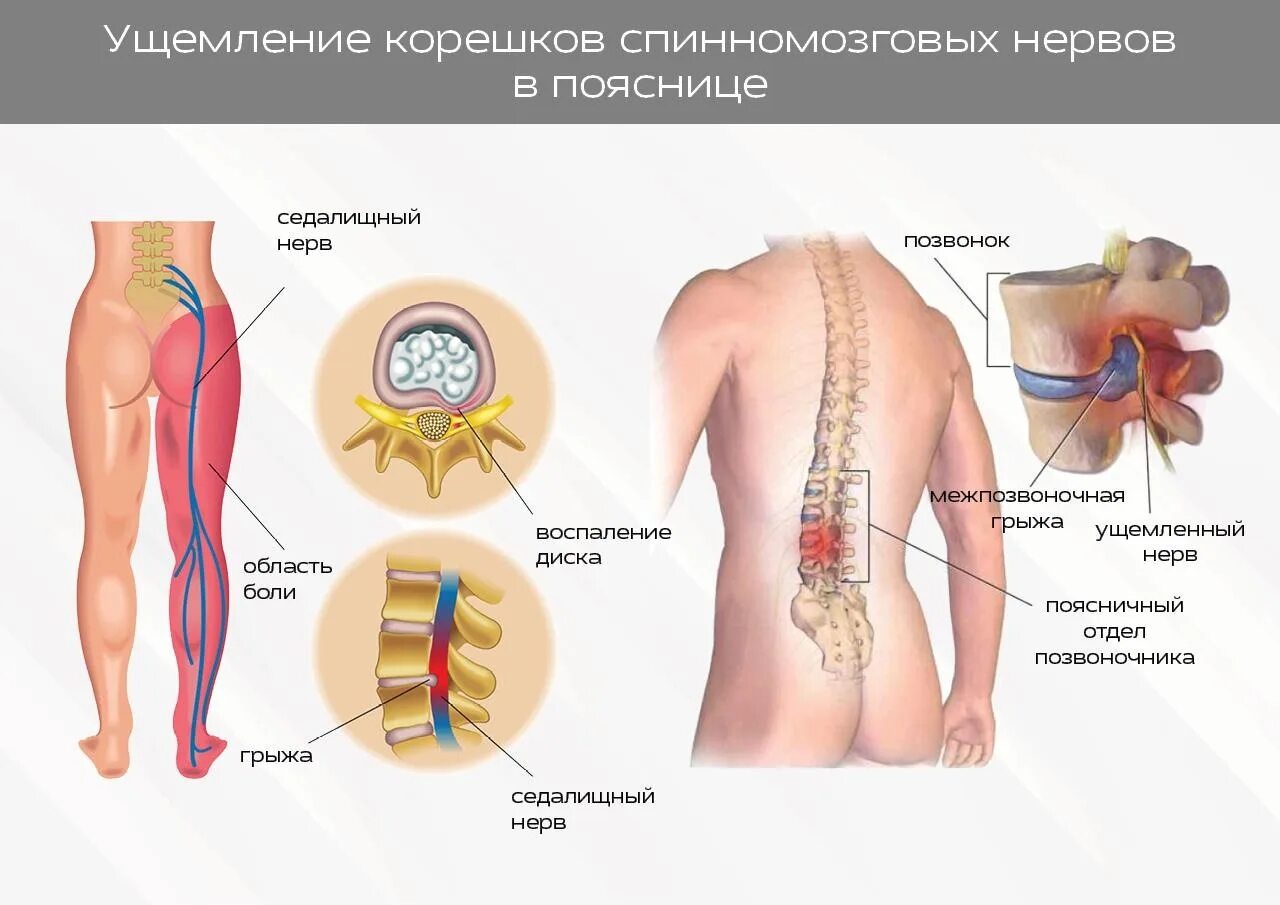 Можно ли греть нерв. Грыжа пояснично-крестцового отдела симптомы. радикулопатия l3 корешка. грыжа позвоночника симптомы пояснично-крестцовый. пояснично-крестцовый отдел позвоночника седалищный нерв.