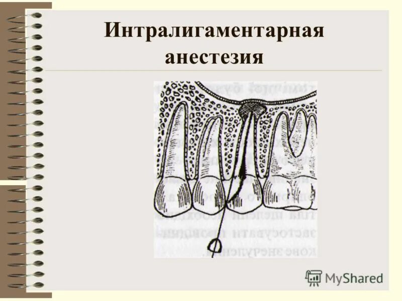 интралигаментарная анестезия в стоматологии. интралигаментарная анестезия в стоматологии. противопоказания к проведению интралигаментарной анестезии. подслизистая инфильтрационная анестезия. интрасептальная анестезия в стоматологии техника.