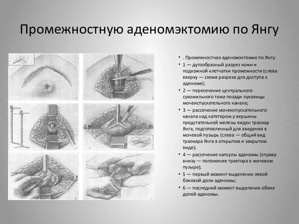 Простатэктомия после операции. Позадилобковая аденомэктомия. Чреспуырная аденомэктомия. Операция Миллина аденомэктомия. Позадилобковая внепузырная аденомэктомия.