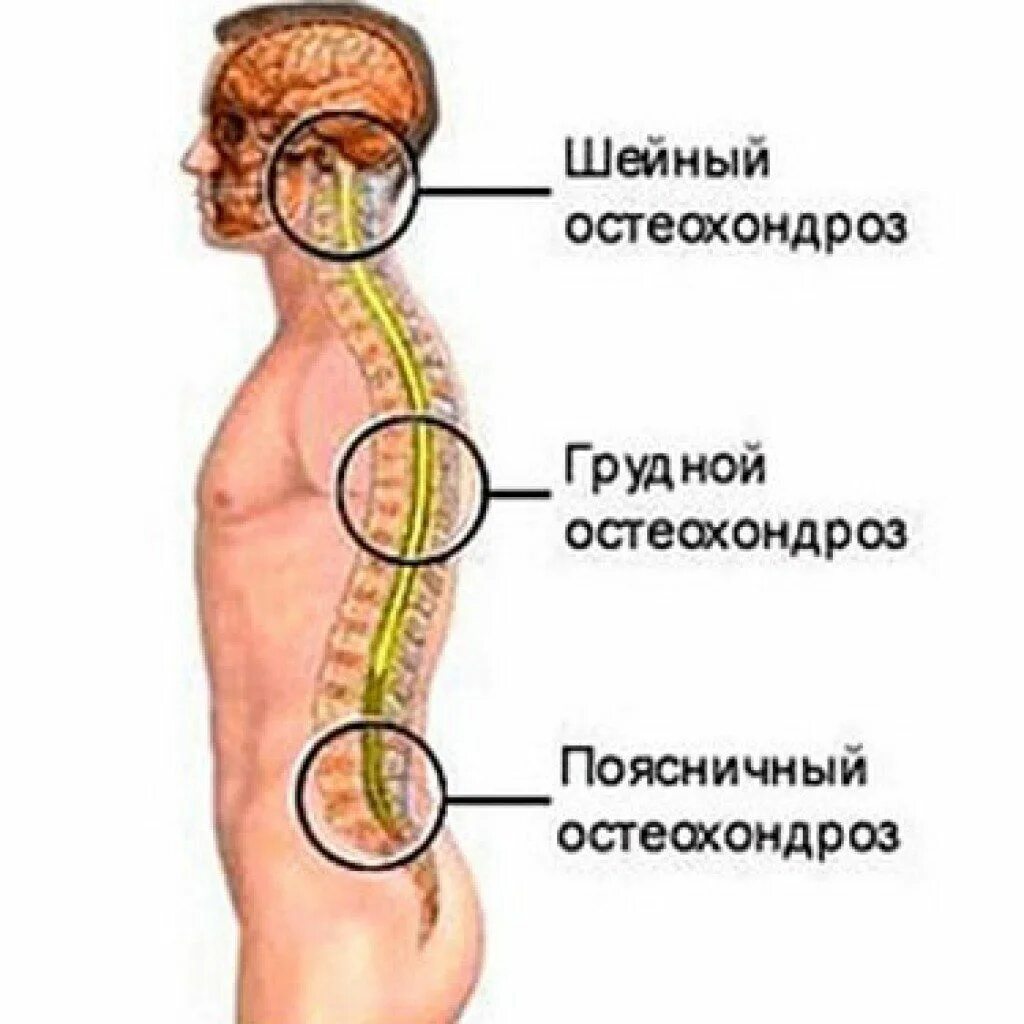 Хондроз шейного отдела позвоночника симптомы. Шейный спондилез. Остеохондроз шейный грудной поясничный. Остеохондроз спондилез спондилоартроз. Деформирующий спондилез l1-l3.