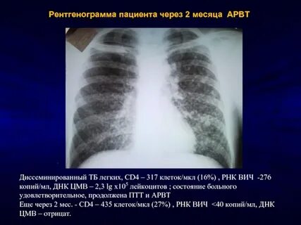 Туберкулез легких при вич