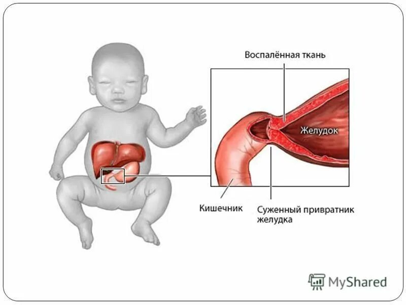 Стеноз кишечника что это. Врожденный гипертрофический пилоростеноз. Пилоростеноз и пилороспазм у новорожденных. Врожденный гипертрофический пилоростеноз у детей. Врожденный гипертрофический пилоростеноз патогенез.