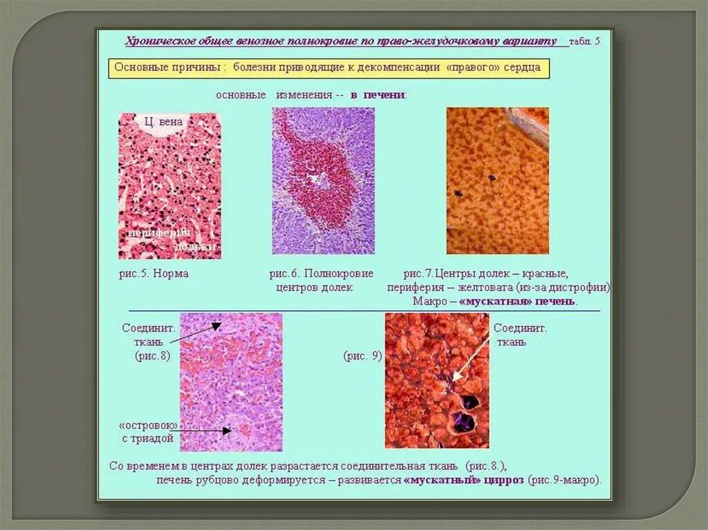 Печень при хроническом венозном застое. Венозное полнокровие печени макропрепарат. Мускатная печень патанатомия макропрепарат. Венозное полнокровие печени гистология. Мускатная печень микропрепарат патанатомия.