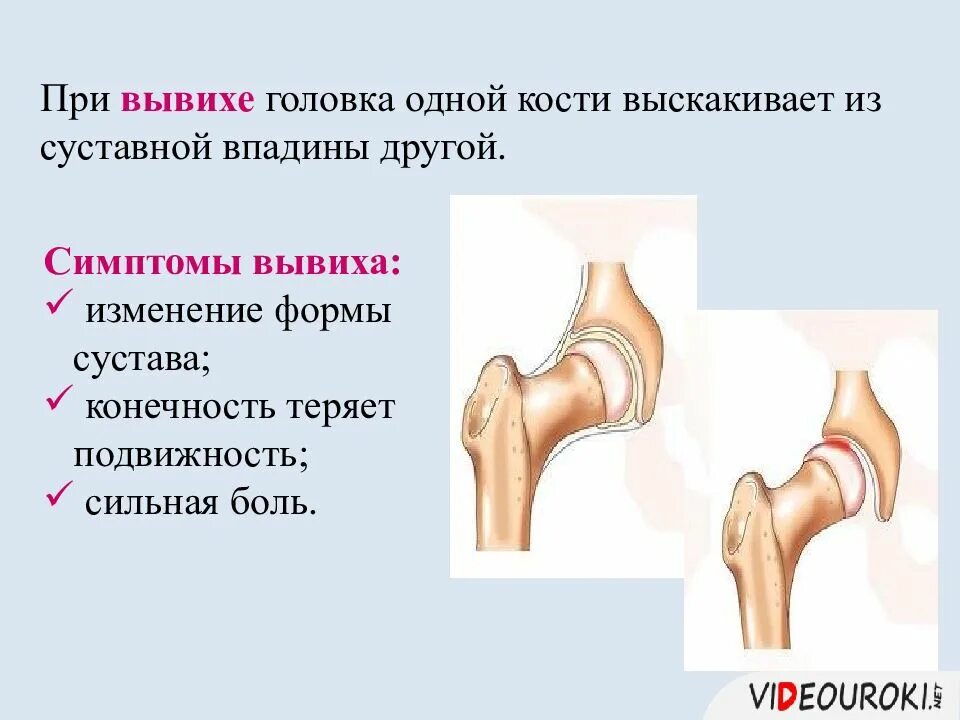 Изменение формы сустава. При вывихе ноги признаки. Признаки вывиха конечности.