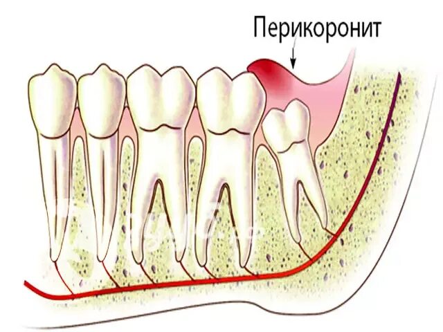 Воспаление зуба мудрости.