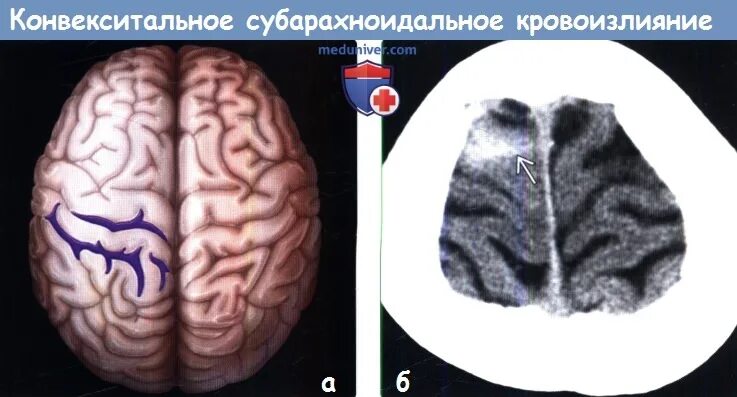 Умеренно расширение конвекситальных пространств. Что такое конвекситальные борозды головного мозга-. Конвекситальное субарахноидальное кровоизлияние кт. Конвекситальная поверхность лобной доли. Перимезенцефальное субарахноидальное кровоизлияние.