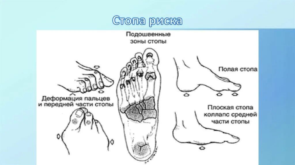 Синдром диабетической стопы мкб 10