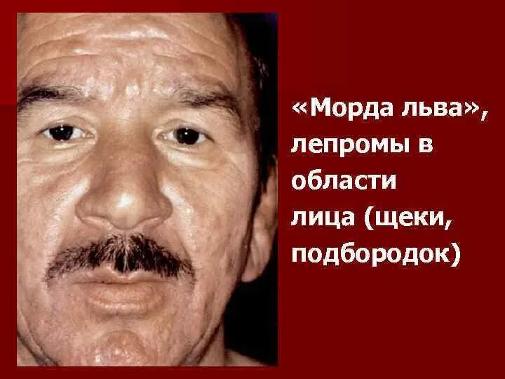 Лепра фото начальная стадия