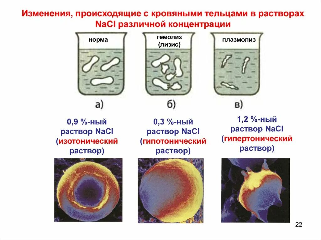 Химические изменения клеток. Гемолиз и плазмолиз эритроцитов. Гемолиз в гипотоническом растворе. Плазмолиз гипертонический раствор. Гипотонический и гипертонический растворы.