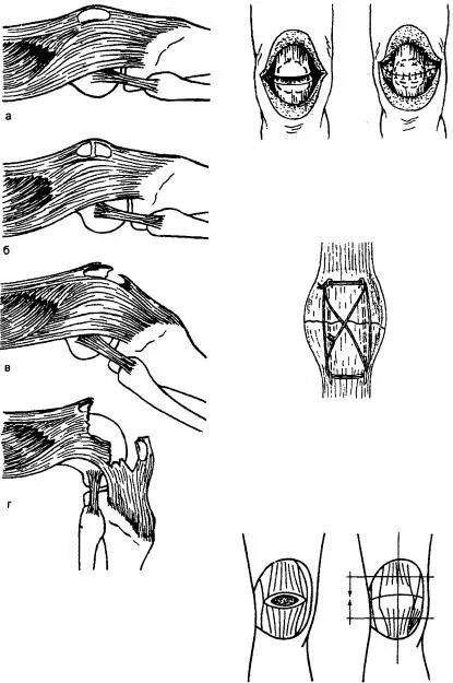 Перелом надколенника фиксация. Операция шов связки надколенника. Фиксация при переломе надколенника. Шов собственной связки надколенника. Перелом надколенника операции