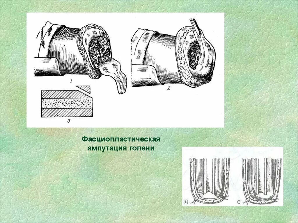 Лоскутная ампутация. Ампутация бедра двухлоскутным. Фасциопластическая ампутация голени. Фасциопластический метод ампутации. Гильотинный метод ампутации.