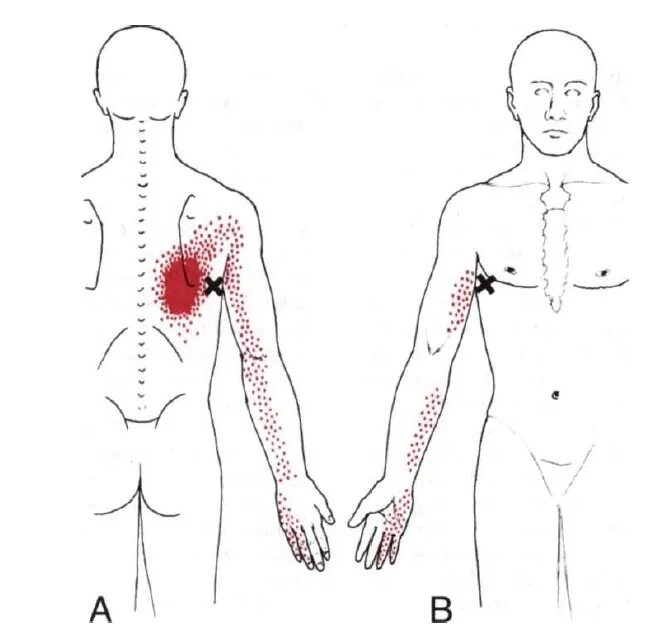 Триггерные точки поясницы. Триггерные точки грудного отдела. Триггерные точки на теле. Триггерные точки на спине схема. Триггерные точки боль мышцы спины.