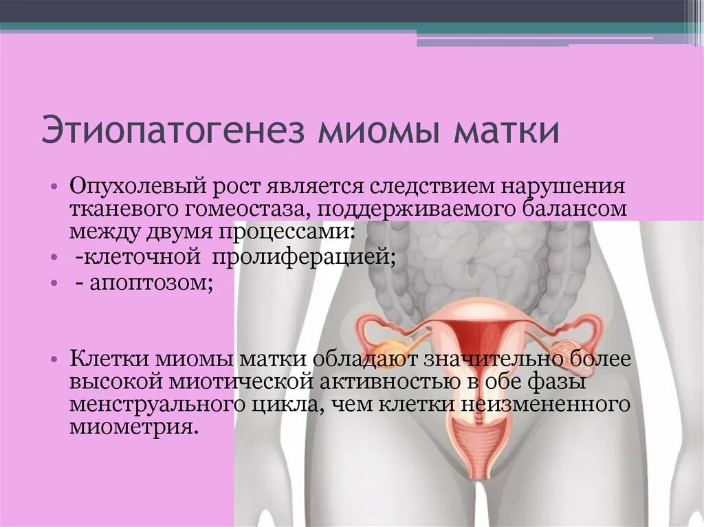 Этиопатогенез миомы матки. Этиопатогенез лейомиомы матки. Вторая фаза миомы матки.