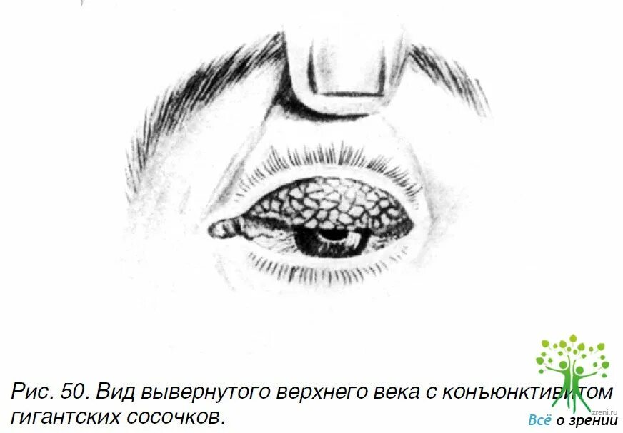 Выворачивание верхнего века симптомы. Соринка под верхним веком. Как вытащить соринку из верхнего века. Попала соринка под верхнее веко.