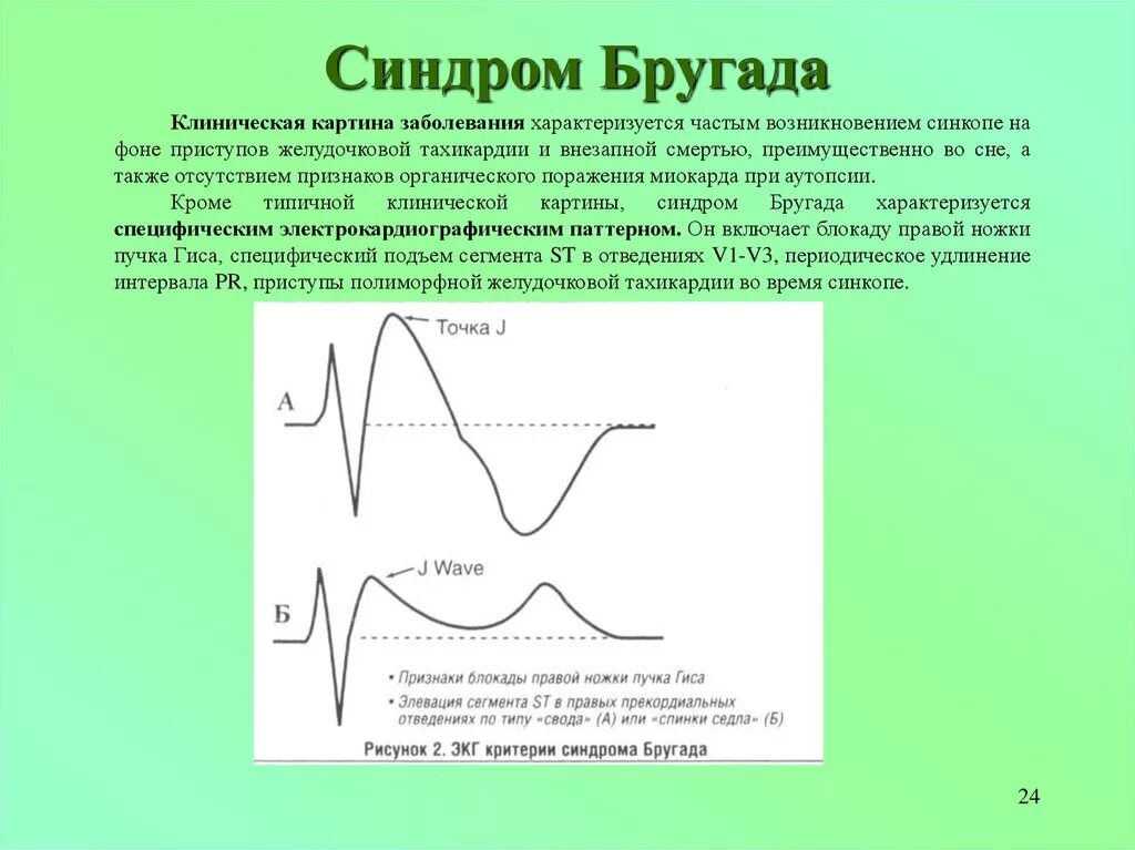 Синдром бругада экг признаки. Диагностические экг критерии синдрома бругада. Экг-критерии синдрома бругада 3 типа. Характерные клинические проявления синдрома бругада. Кардиограмма при синдроме бругада.