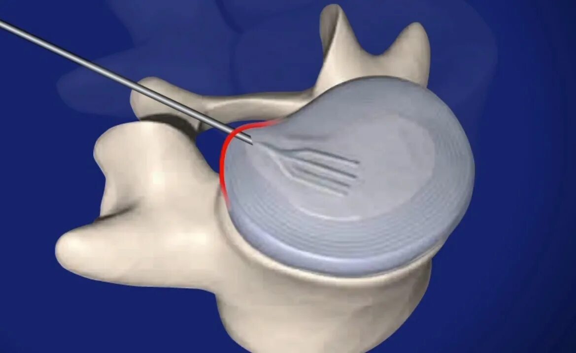 Декомпрессивная нуклеопластика. Пункционная нуклеопластика. Нуклеопластика межпозвонкового диска холодноплазменная. Нуклеопластика грыжи шейного. Грыжа лазерная операция