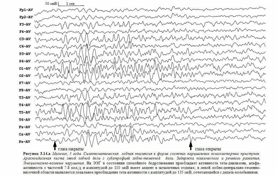 Ээг 7. Возрастные нормы Альфа ритма на ЭЭГ. Нормальный рисунок ЭЭГ. Дельта ритм на ЭЭГ У взрослых. Депрессия Альфа-ритма ЭЭГ что это.